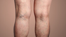 The Varicose Veins On A Legs Of Woman