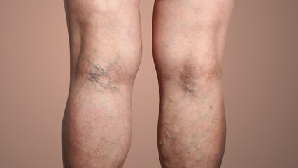 The varicose veins on a legs of woman