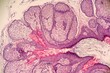 Hyperplastic sebeceous Glands of the Skin surrounding a dilated follicle. Microscopic view.