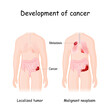 Cancer development. colon cancer and metastasis in lungs