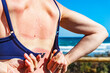 © anetlanda - Woman back skin hurt from sun burn.