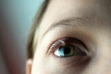 Fototapeta Tulipany - Close-up of a child's eye stye. Ophthalmic hordeolum disease.