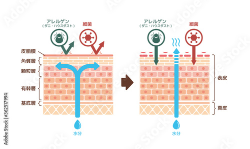 健康な皮膚とアトピー性皮膚炎 比較断面図イラスト Vector De Stock Adobe Stock