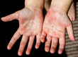 Red rash on the hands of the palms of the child, rubella scarlet fever Coxsackie and other infectious viral diseases in children and adults