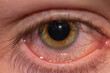 A close up of someones eye when its extremely bloodshot from being tired or exhausted.