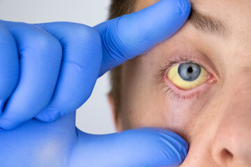 The yellow color of the male eye. Symptom of jaundice, hepatitis or problems with the gall bladder, gastrointestinal tract, liver.