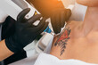 Laser tattoo removal from shoulder