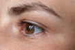 Macro eye photo. Keratoconus - eye disease, thinning of the cornea in the form of a cone. The cornea plastic