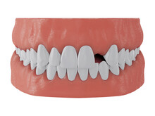 Jaw With Missing Front Tooth Deuce On White Background, 3d Render