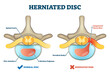 Herniated disc injury as labeled spinal pain explanation vector illustration