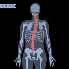 Poster - Spine X ray