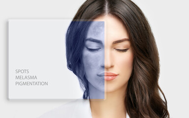 Dark spots, freckles,hyperpigmentation(melasma or chloasma),concept- skin lightening, skin whitening, Skin Brightening