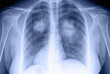  X-ray of human pneumonia lungs