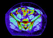 Color CAT scan of the pelvis..