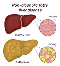 Illustration Of Non-alcoholic Fatty Liver Disease. For Comparison Shows The Healthy And Diseased Liver