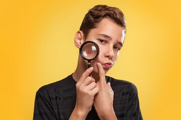 Wall Mural - Cosmetology, Dermatology and acne. A teenage boy in a black t-shirt with pimples on his face, holding a magnifying glass to his cheek. Yellow background