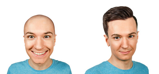 bald man before and after transplant hair and alopecia. Isolated on white background.