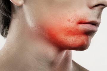 Sensitive skin irritation after a shaving routine