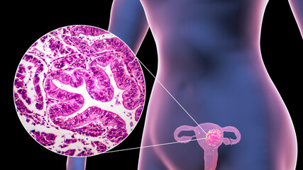 Sticker - Uterine cancer, illustration and micrograph