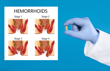 Wall Mural - Doctor holding suppository for hemorrhoid treatment near illustration of lower rectum progressing disease, blue background