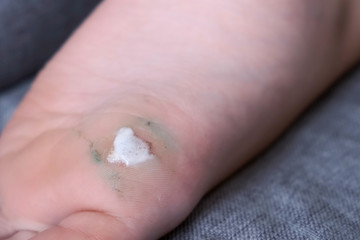 Disinfecting wound after laser removal on foot hydrogen peroxide, closeup view. Care and treatment in medicine after surgical operation.