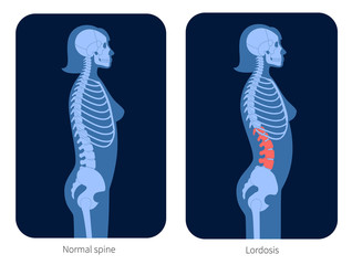 Poster - Spine X ray