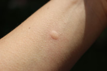Mosquito Bite On A Female Adult Hand On Black Dark Background
