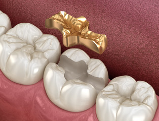 Wall Mural - Golden Inlay crown fixation over tooth. Medically accurate 3D illustration of human teeth treatment