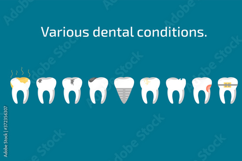 Fotografía Various teeth conditions healthy, caries and dental implant.
