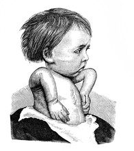 Child With Hand Pathology In The Old Book Sauglingsernahrung By Dr. Huebner, Berlin, 1897