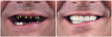 Before And After Pictures Of Dental Implants And Press Cerami Crowns