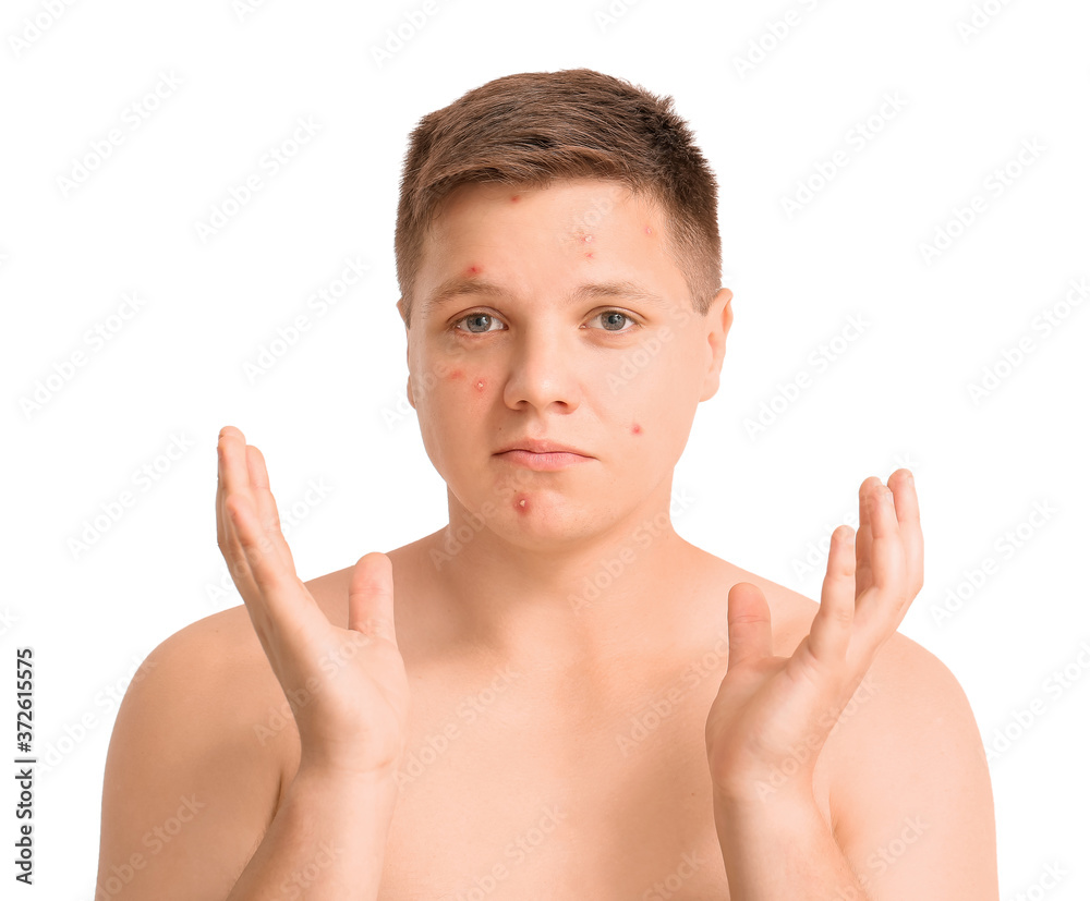 Teenage boy with acne on white background