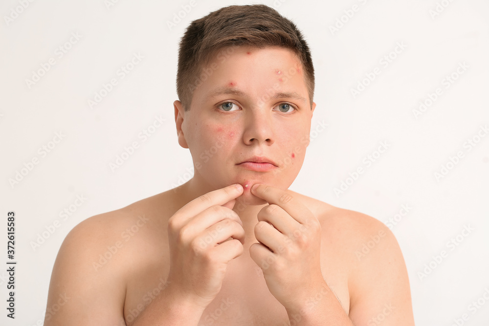 Teenage boy with acne squishing pimples on light background