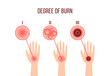 © Halyna - infographics of different degrees of burn