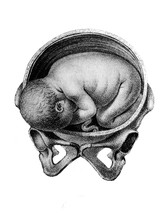 Baby On The Side Inside The Woman's Womb In The Old Book Atlas Abildungen By D. W. Busch, Berlin, 1841