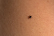 © Arina B - Tick Acari mite on human skin. Dangerous insects.