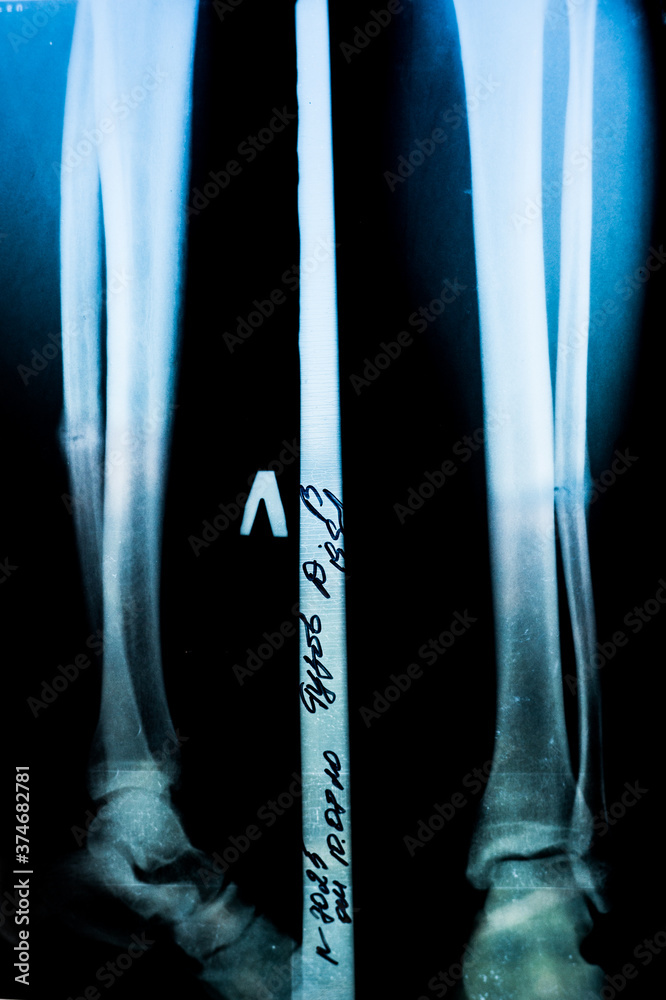 Foto de Stock X-ray of a patient with a fracture of the fibula of the ...