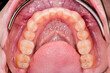 © Dirk - lower jaw after orthodontic treatment
