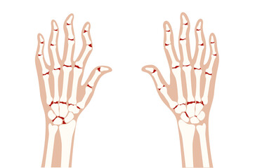 Poster - Arthrits x ray