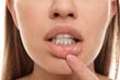 Young woman with cold sore touching lip, closeup