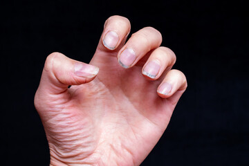 Wall Mural - Close-up of female caucasian hand with dirty brittle nails, broken nails on a black background. Peeling on nails