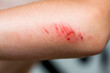 Children injury. Deep scratches on the skin on the kids elbow hand. Wounds, scratches, abrasions on the child arm