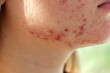 Pimples on the cheek of a girl close-up