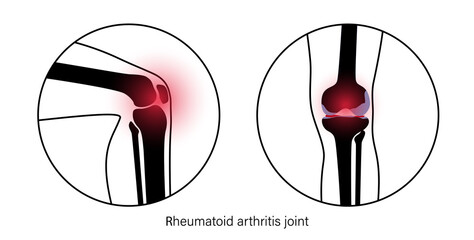 Canvas Print - Arthritis in knee joint