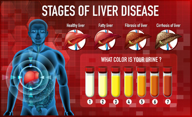 Poster - Stages of liver disease