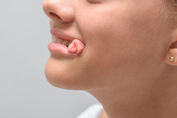 Fototapeta a bloody swab sticks out of the mouth of a ten-year-old girl after tooth extraction, close-up