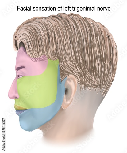 facial sensory loss from trigeminal nerve lesion. Stock Illustration ...
