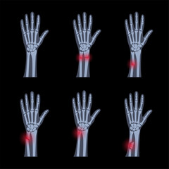 Sticker - Fracture x ray concept