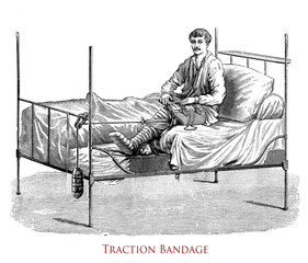 Healthcare and medicine: drawing explaining how to perform a traction bandage for broken leg, vintage illustration