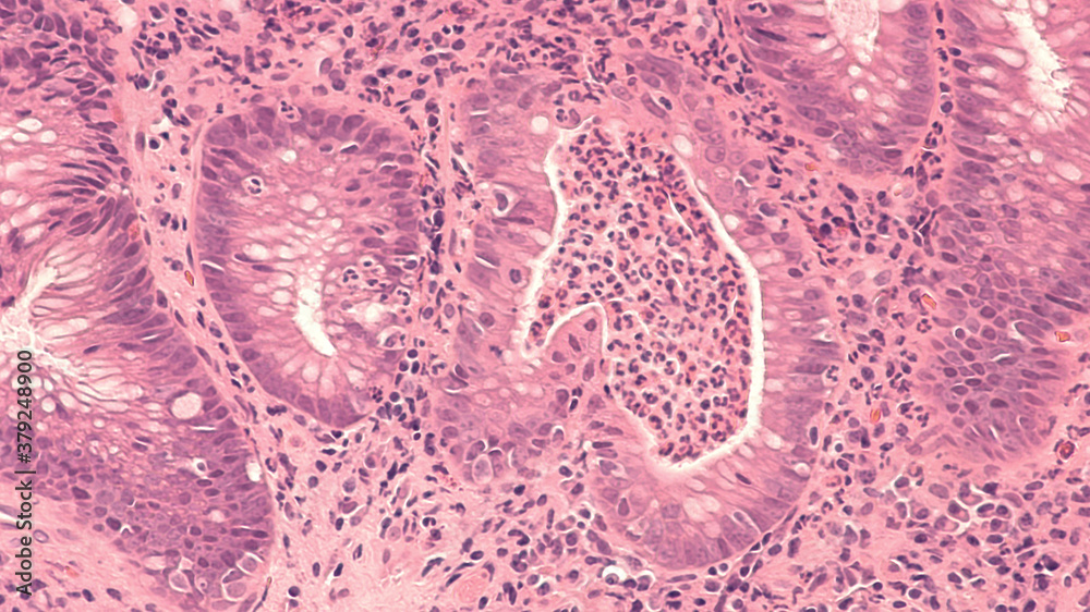 Cryptogenic Colitis Photomicrograph of a colon biopsy obtained during colonoscopy showing ...